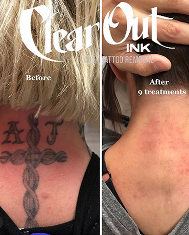 After laser tattoo removal progress photo in Las Vegas