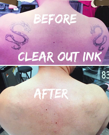 Before laser tattoo removal progress photo in Las Vegas