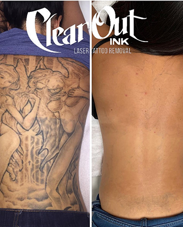 After laser tattoo removal progress photo in Las Vegas