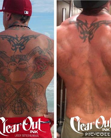 After laser tattoo removal progress photo in Las Vegas