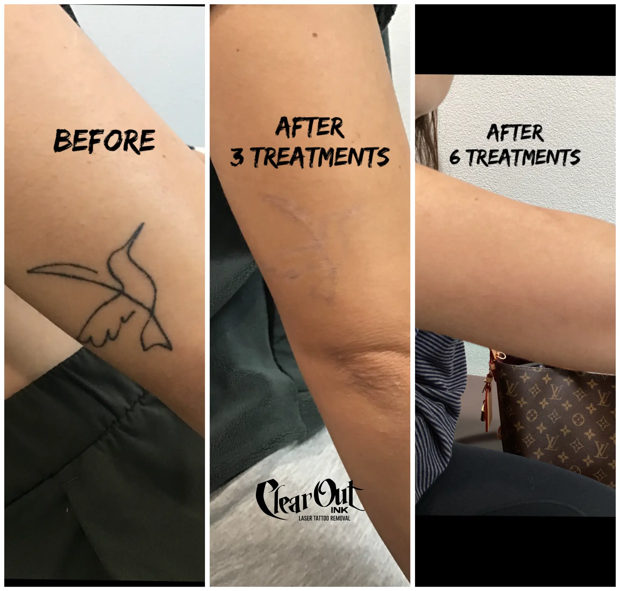 After laser tattoo removal progress photo in Las Vegas