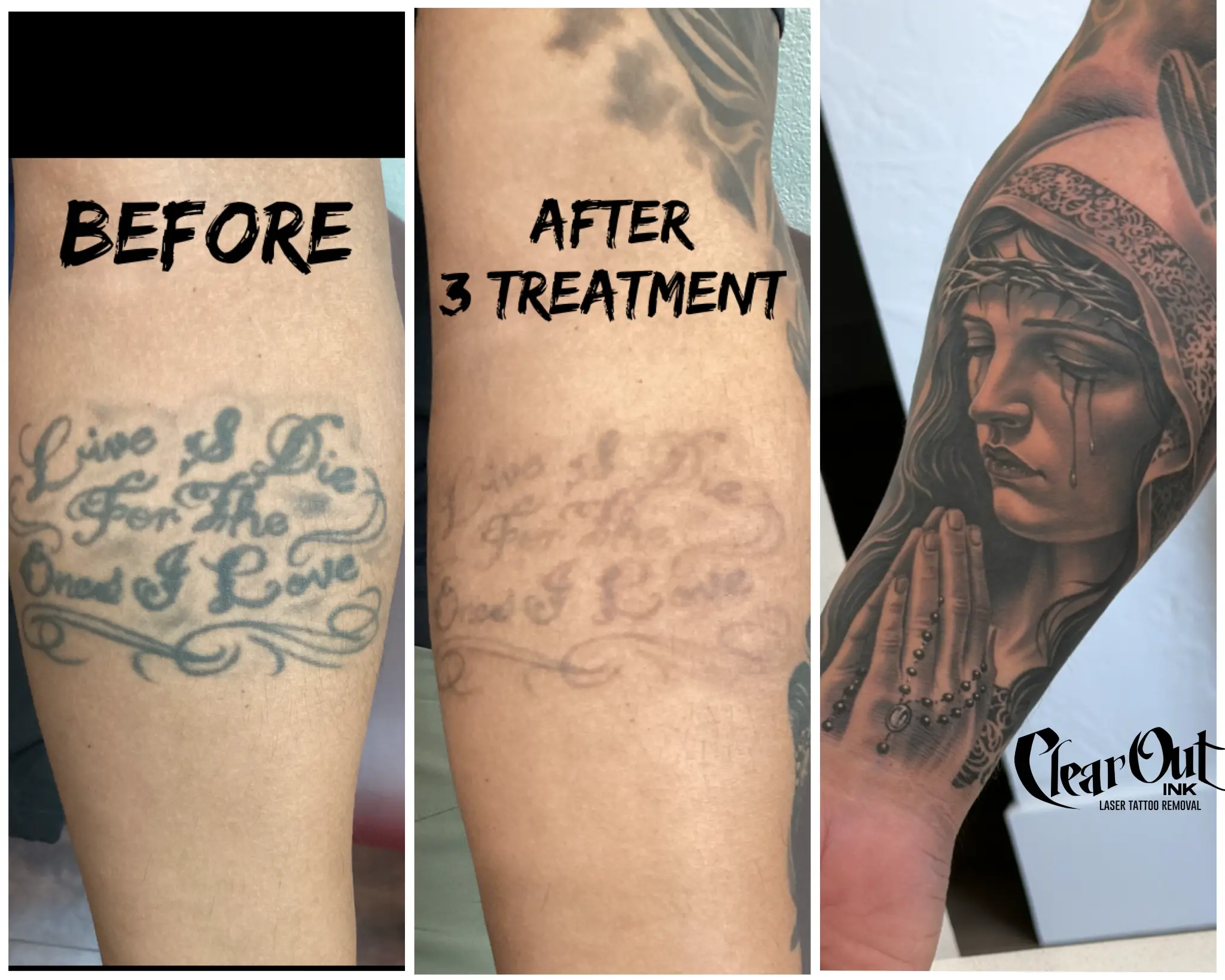 After laser tattoo removal progress photo in Las Vegas