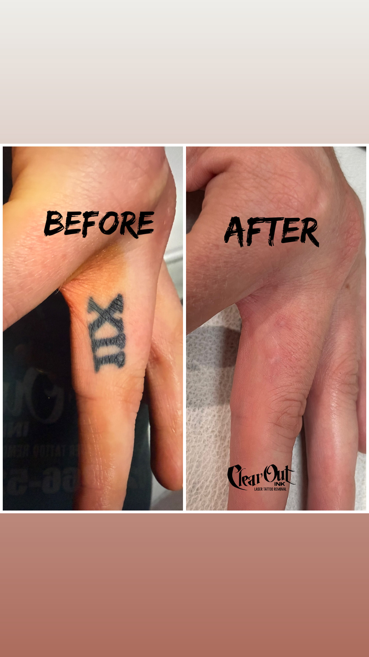 Before laser tattoo removal progress photo in Las Vegas