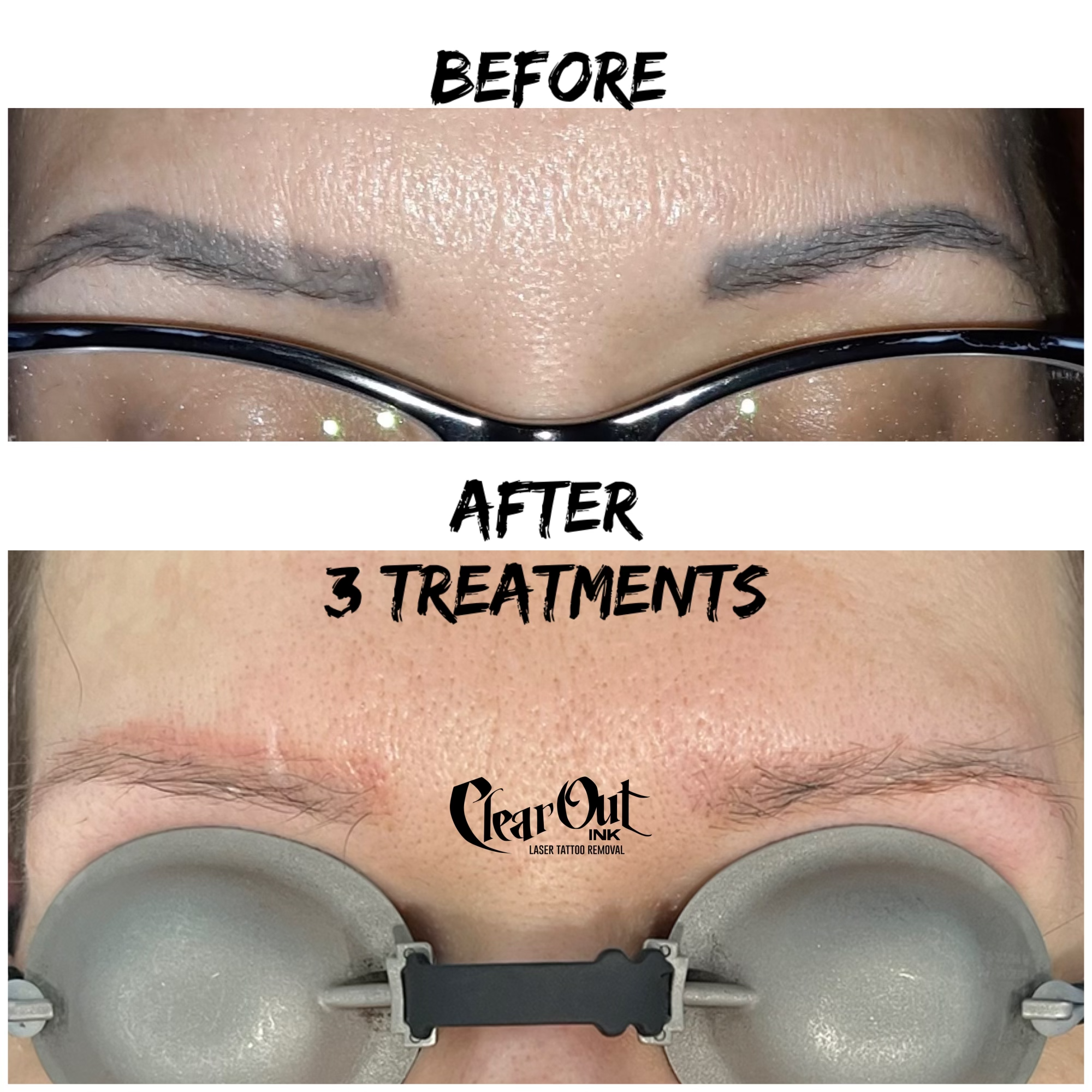 After laser tattoo removal progress photo in Las Vegas