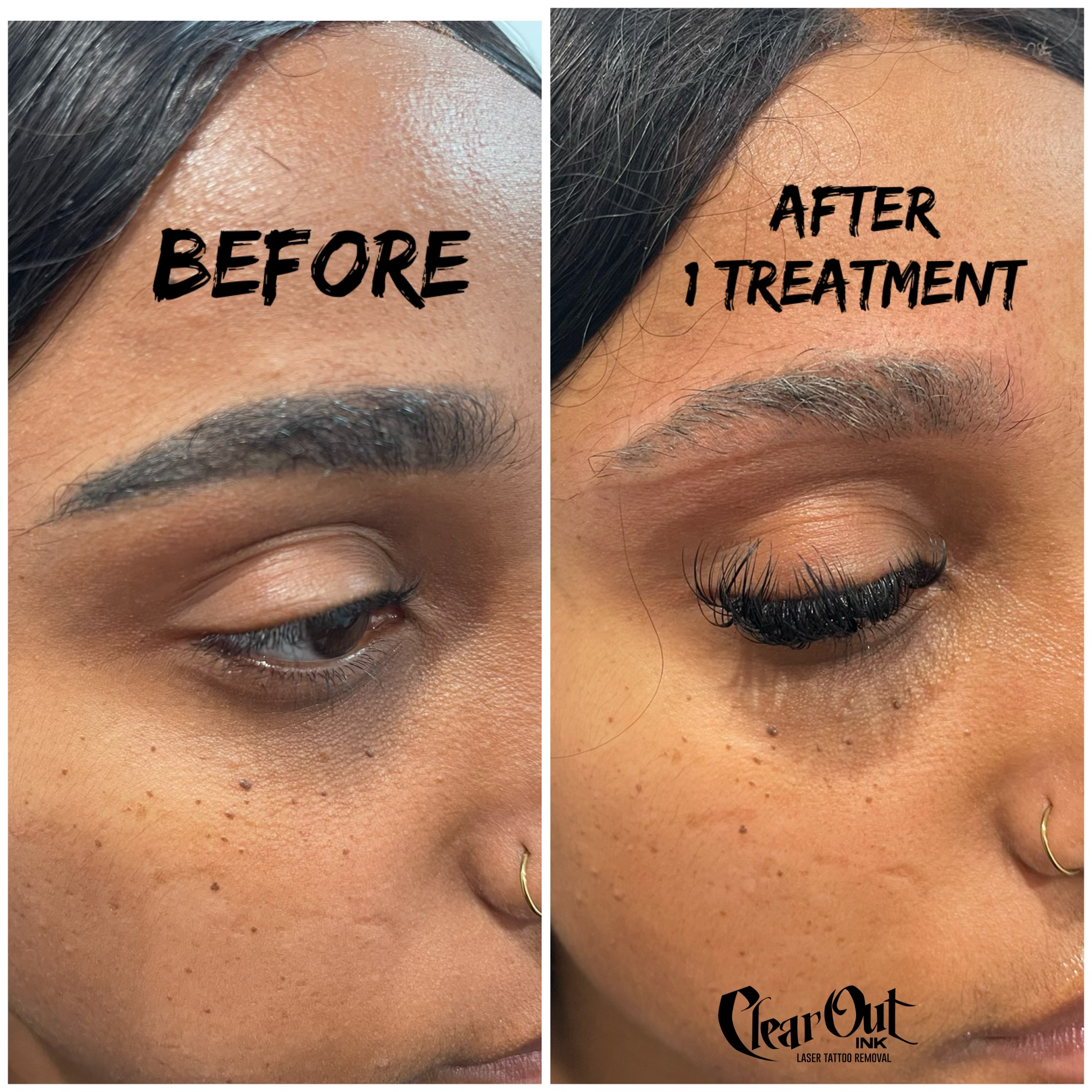 Before laser tattoo removal progress photo in Las Vegas