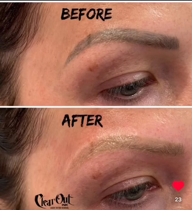 After laser tattoo removal progress photo in Las Vegas