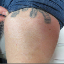 Tattoo Removal In Las Vegas : Las Vegas Tattoo Artists - 702 Tattoo Shops Las Vegas, NV ... - We perform, educate and set expectations on the process of laser tattoo removal.